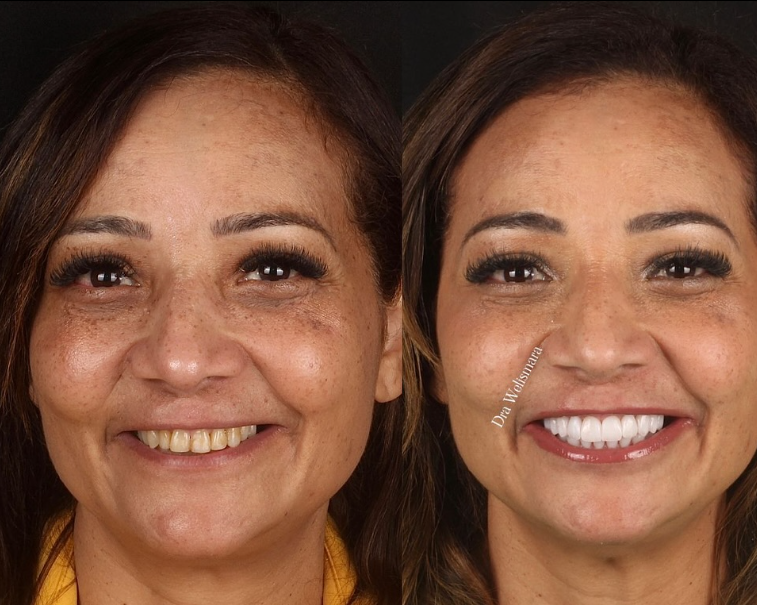 Antes e depois — procedimento 7